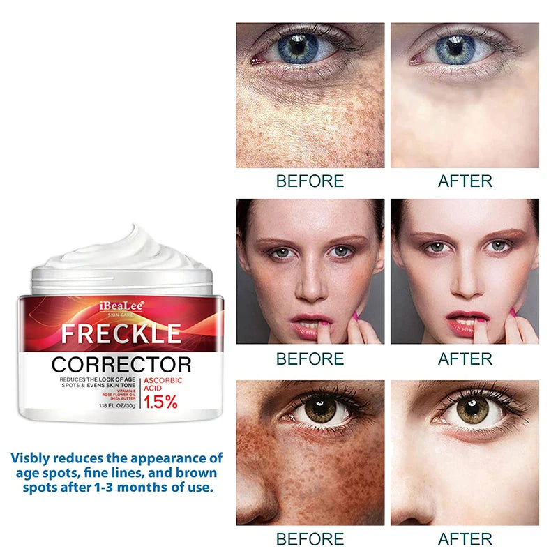 Crème correctrice de taches de rousseur pour le visage, élimine les points noirs, mélasma, Anti-taches brunes, éclaircit la Pigmentation, hydrate, soins de la peau, cosmétiques