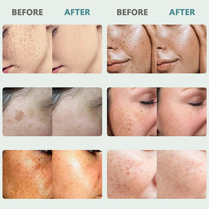 Crème correctrice de taches de rousseur pour le visage, élimine les points noirs, mélasma, Anti-taches brunes, éclaircit la Pigmentation, hydrate, soins de la peau, cosmétiques