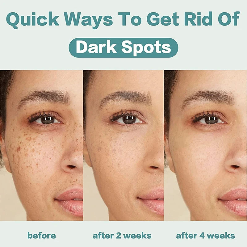 Crème correctrice de taches de rousseur pour le visage, élimine les points noirs, mélasma, Anti-taches brunes, éclaircit la Pigmentation, hydrate, soins de la peau, cosmétiques