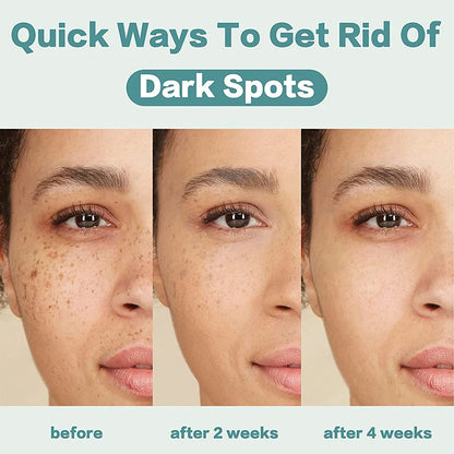 Crème correctrice de taches de rousseur pour le visage, élimine les points noirs, mélasma, Anti-taches brunes, éclaircit la Pigmentation, hydrate, soins de la peau, cosmétiques
